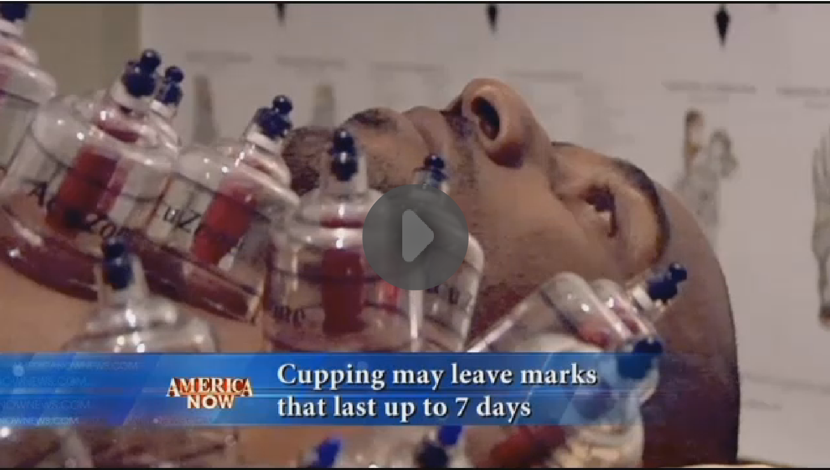 Body Cupping For Tissue Repair And Pain Management - CandyLipz