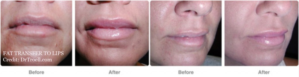 Are Fat Injections The Best For Lip Enhancement Candylipz