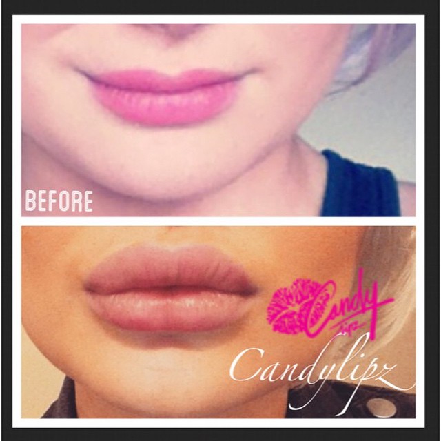 CandyLipz Lip Enhancement Before and After Images 5 CandyLipz