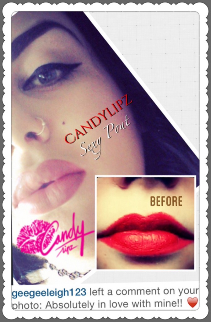 Outrageous Lip Suction Before and After Photos 11 CandyLipz