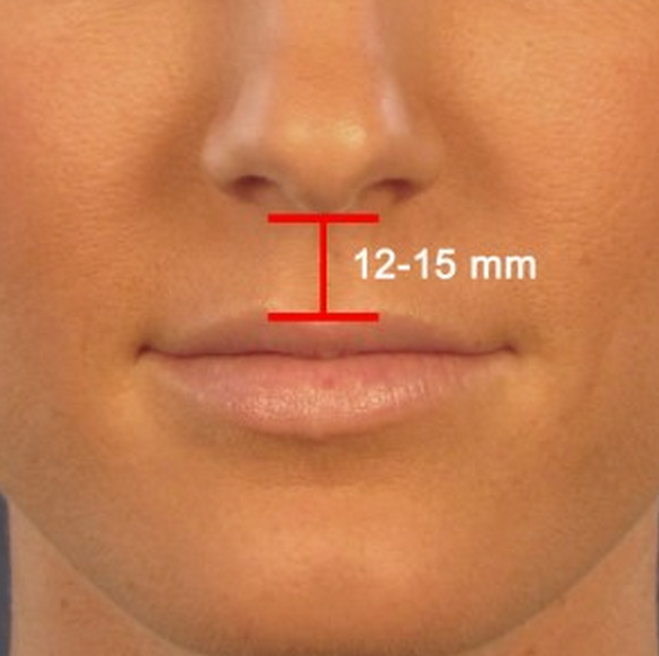 Операция нижней губы. Между верхней губой и носом. Складка между носом и губой. Желобок между носом и верхней губой.